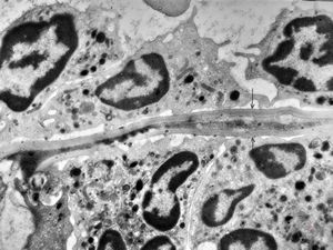 M,43y. | blood - degraded Candida (bone marrow suppression)